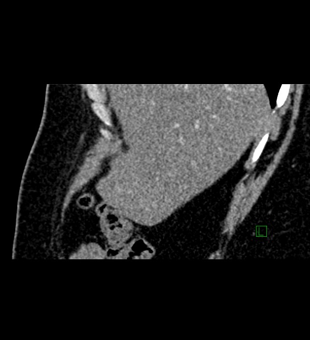Chromophobe renal cell carcinoma (Radiopaedia 84286-99573 F 153).jpg