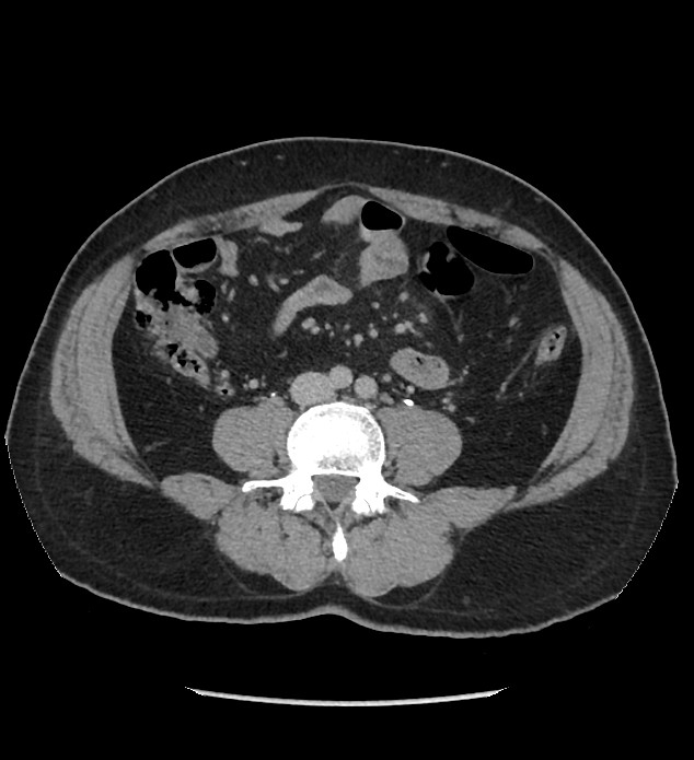 Chromophobe renal cell carcinoma (Radiopaedia 86879-103083 D 88).jpg
