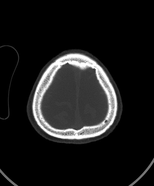 Chronic bilateral subdural hygroma (Radiopaedia 85801-101623 Axial bone window 22).jpg