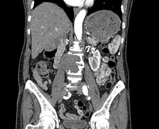File:Chronic contained rupture of abdominal aortic aneurysm with extensive erosion of the vertebral bodies (Radiopaedia 55450-61901 D 41).jpg