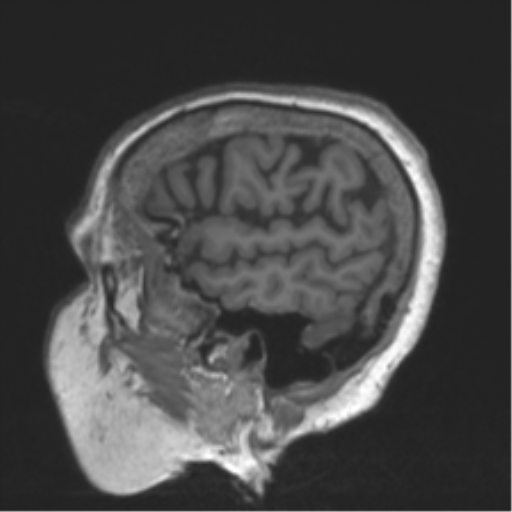 File:Chronic hypertensive encephalopathy (Radiopaedia 39993-42482 Sagittal T1 77).png