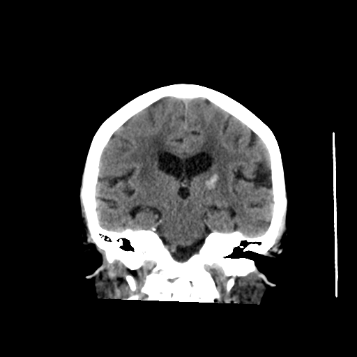 File:Chronic hypertensive encephalopathy (Radiopaedia 39993-42485 Axial non-contrast 1).png