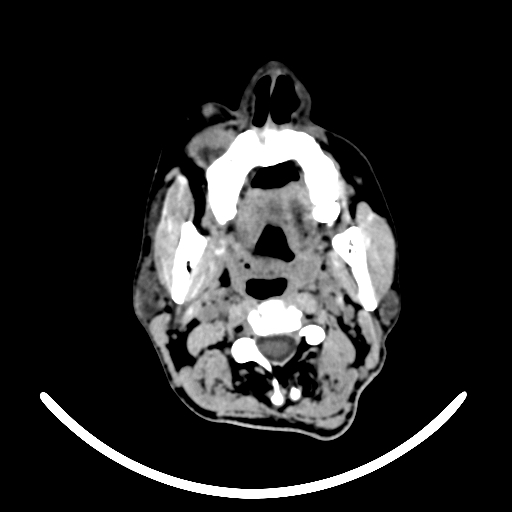 File:Chronic invasive fungal sinusitis with intraorbital and intracranial extension (Radiopaedia 56387-63046 Axial non-contrast 21).jpg