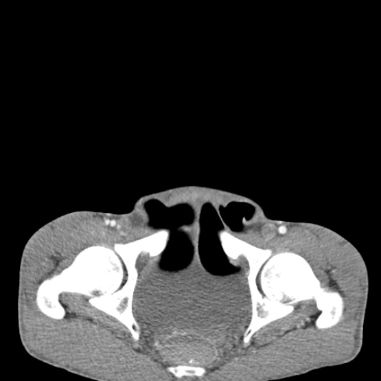 Chronic large bowel pseudo-obstruction (Radiopaedia 43181-46492 A 157).jpg