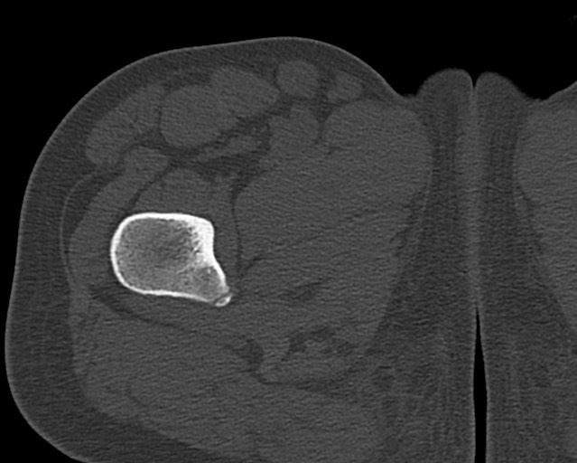 File:Chronic ostemyelitis of the femur with long sinus tract (Radiopaedia 74947-85982 Axial bone window 25).jpg