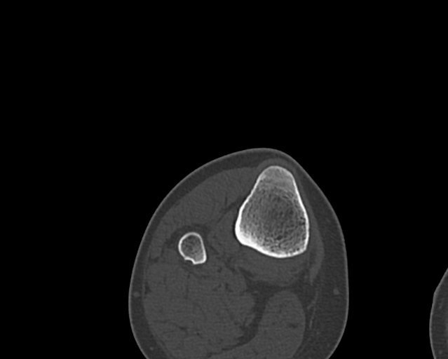 File:Chronic ostemyelitis of the femur with long sinus tract (Radiopaedia 74947-85982 Axial bone window 254).jpg
