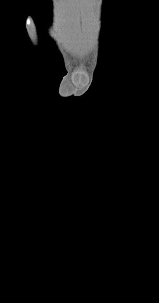 Chronic osteomyelitis (with sequestrum) (Radiopaedia 74813-85822 E 2).jpg