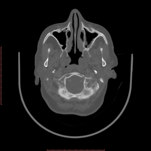 Chronic osteomyelitis - maxilla (Radiopaedia 23783-23927 Axial bone window 109).jpg