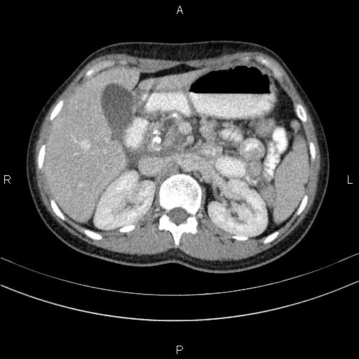 File:Chronic pancreatitis (Radiopaedia 64576-73450 C 48).jpg