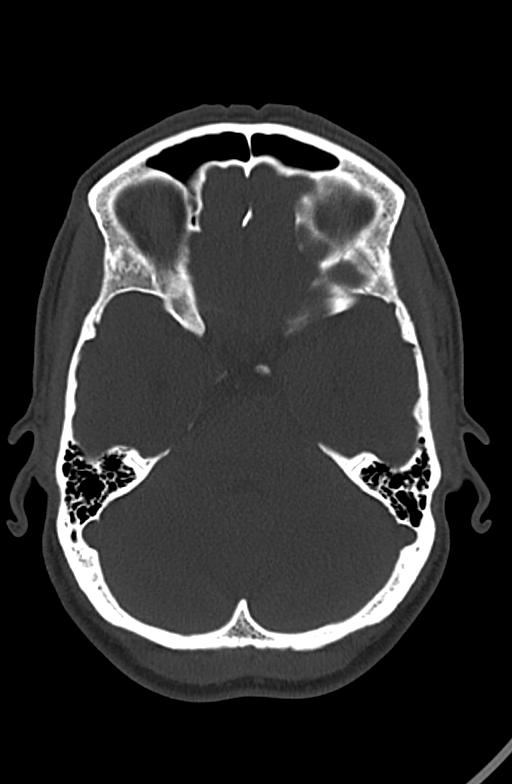 Chronic secondary hypoparathyroidism (Radiopaedia 74645-85601 Axial bone window 71).jpg