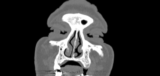 Chronic sphenoidal sinusitis (Radiopaedia 62030-70122 Coronal bone window 15).jpg