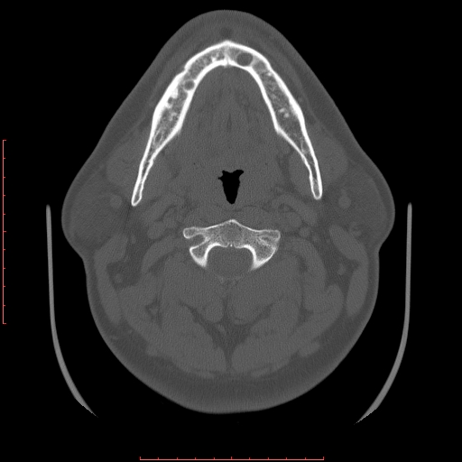 Chronic submandibular sialolithiasis (Radiopaedia 69817-79814 Axial bone window 58).jpg