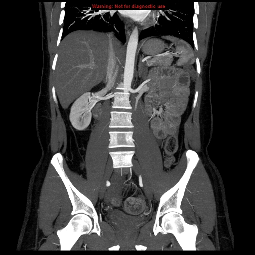 File:Circumaortic left renal vein (Radiopaedia 9069-9792 B 20).jpg