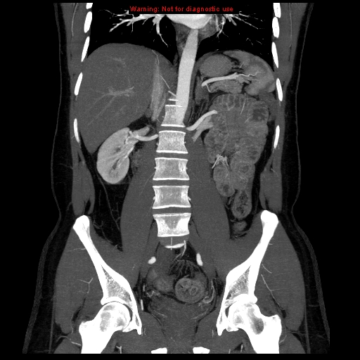 File:Circumaortic left renal vein (Radiopaedia 9069-9792 B 21).jpg