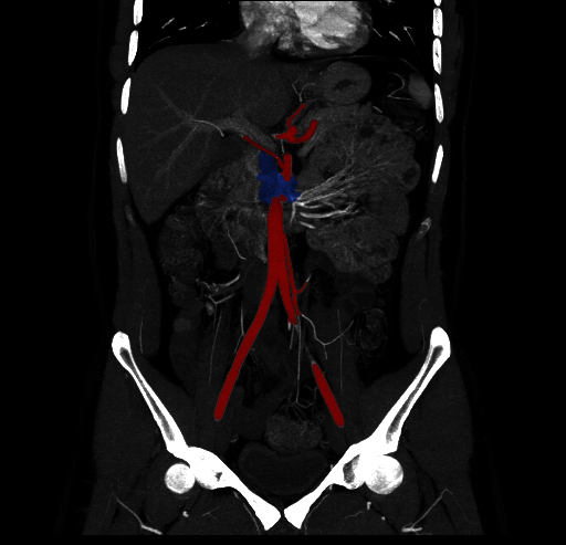 File:Circumaortic left renal vein (Radiopaedia 9069-9792 C 1).jpg