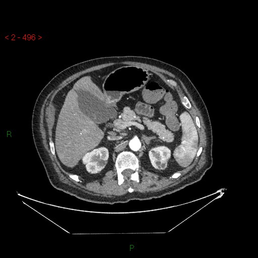 Circumaortic left renal vein and doubled left renal arteries (Radiopaedia 52268-58158 A 32).jpg
