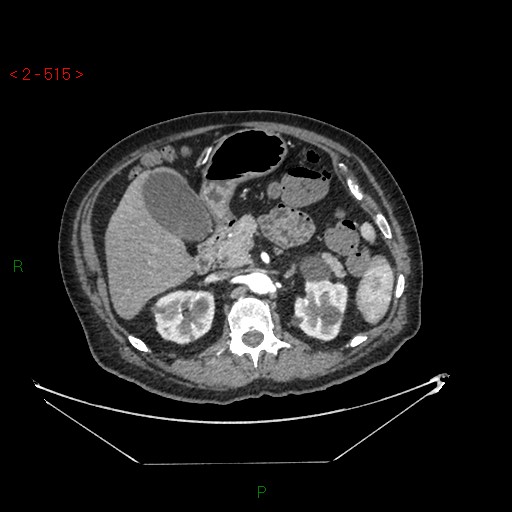 File:Circumaortic left renal vein and doubled left renal arteries (Radiopaedia 52268-58158 A 51).jpg