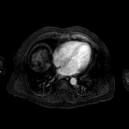 Cirrhosis and hepatocellular carcinoma in the setting of hemochromatosis (Radiopaedia 75394-86594 Axial T1 C+ fat sat 166).jpg