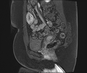 Class II Mullerian duct anomaly- unicornuate uterus with rudimentary horn and non-communicating cavity (Radiopaedia 39441-41755 G 41).jpg