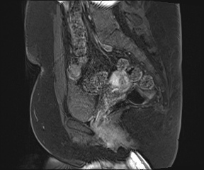 File:Class II Mullerian duct anomaly- unicornuate uterus with rudimentary horn and non-communicating cavity (Radiopaedia 39441-41755 G 66).jpg