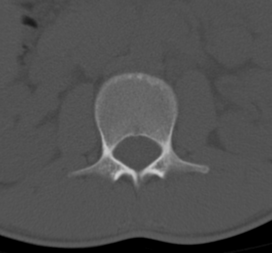 Clear cell meningoma - lumbar spine (Radiopaedia 60116-67691 Axial bone window 16).png