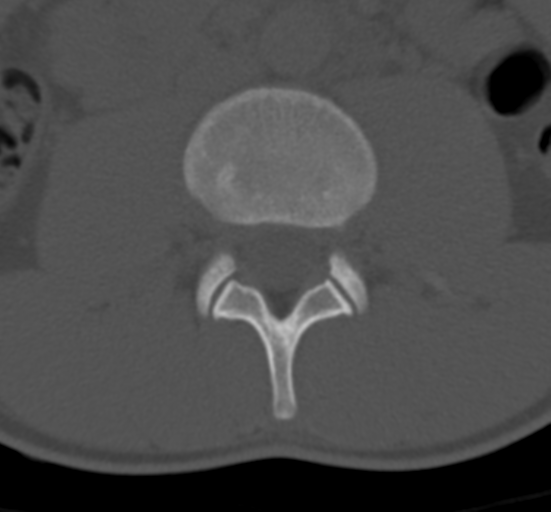 Clear cell meningoma - lumbar spine (Radiopaedia 60116-67691 Axial bone window 34).png