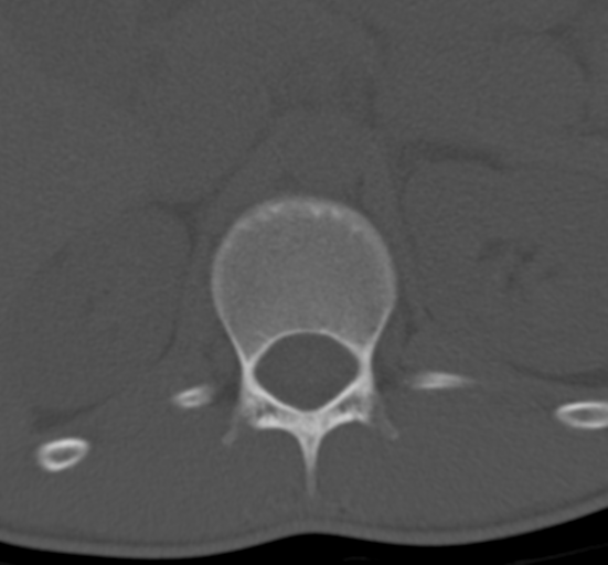 Clear cell meningoma - lumbar spine (Radiopaedia 60116-67691 Axial bone window 5).png