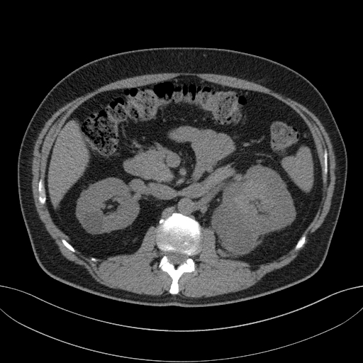 File:Clear cell renal cell carcinoma (Radiopaedia 61449-69393 Axial non-contrast 33).jpg