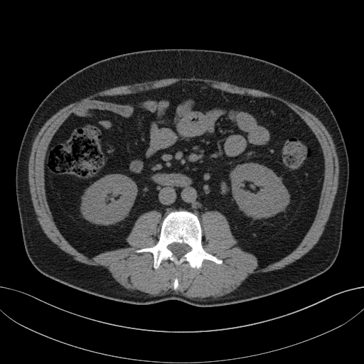 File:Clear cell renal cell carcinoma (Radiopaedia 61449-69393 Axial non-contrast 52).jpg