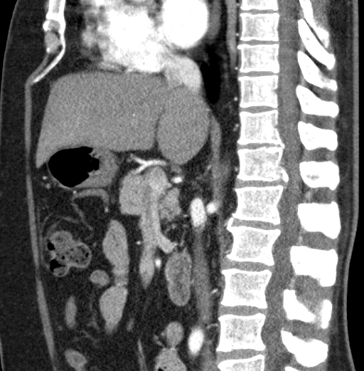 File:Clear cell renal cell carcinoma (Radiopaedia 61449-69393 D 59).jpg