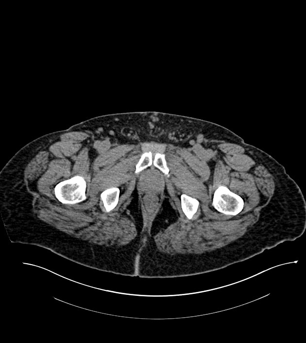 Closed-loop small bowel obstruction-internal hernia (Radiopaedia 78439-91096 Axial non-contrast 160).jpg