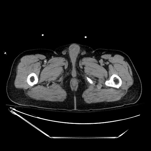 File:Closed loop obstruction due to adhesive band, resulting in small bowel ischemia and resection (Radiopaedia 83835-99023 Axial non-contrast 176).jpg