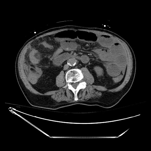 Closed loop obstruction due to adhesive band, resulting in small bowel ischemia and resection (Radiopaedia 83835-99023 Axial non-contrast 80).jpg