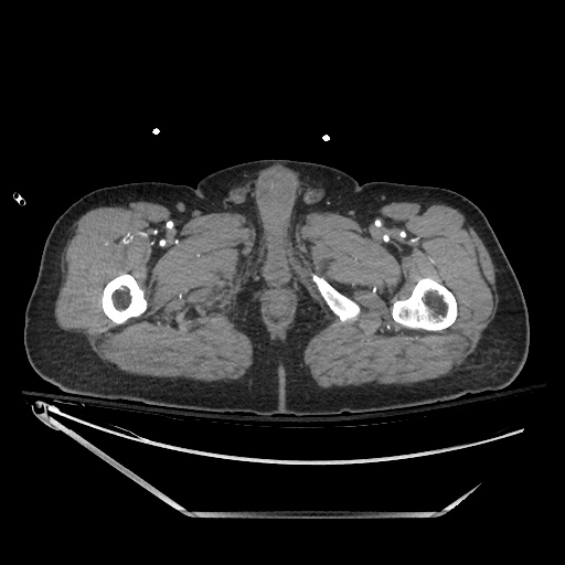 File:Closed loop obstruction due to adhesive band, resulting in small bowel ischemia and resection (Radiopaedia 83835-99023 B 173).jpg