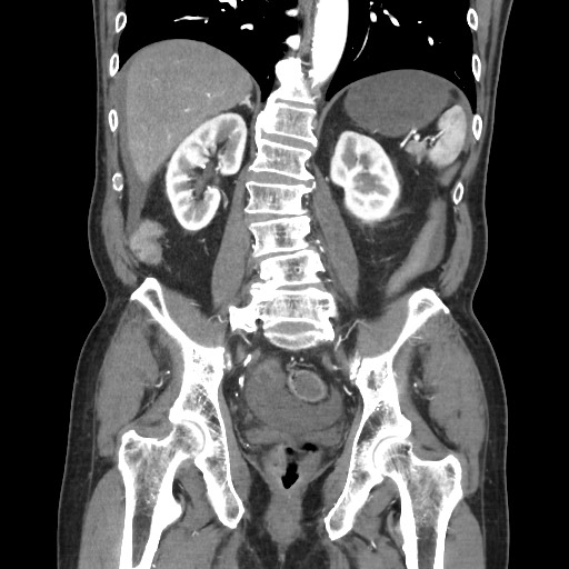 Closed loop obstruction due to adhesive band, resulting in small bowel ischemia and resection (Radiopaedia 83835-99023 C 83).jpg