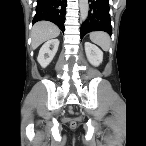 File:Closed loop small bowel obstruction (Radiopaedia 59227-66554 B 37).jpg