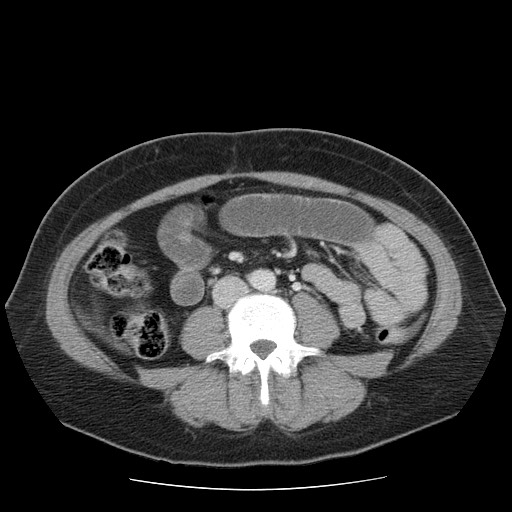 File:Closed loop small bowel obstruction (Radiopaedia 65403-74451 Axial 5).jpg
