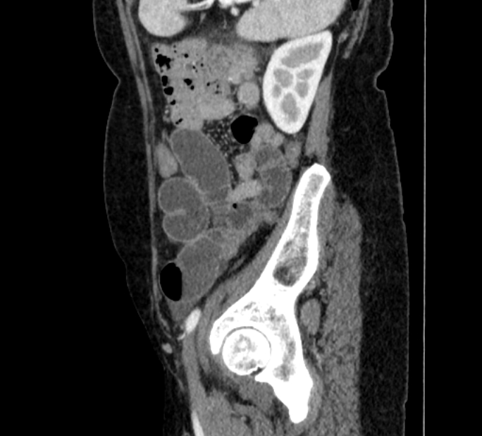 Closed loop small bowel obstruction (Radiopaedia 71211-81508 C 130).jpg