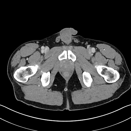 Closed loop small bowel obstruction - internal hernia (Radiopaedia 57806-64778 B 131).jpg