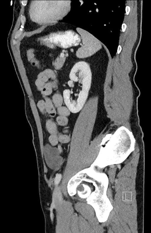 Closed loop small bowel obstruction - internal hernia (Radiopaedia 57806-64778 C 36).jpg