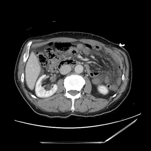Closed loop small bowel obstruction - omental adhesion causing "internal hernia" (Radiopaedia 85129-100682 A 70).jpg