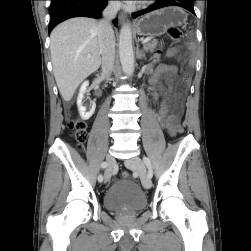 Closed loop small bowel obstruction - omental adhesion causing "internal hernia" (Radiopaedia 85129-100682 B 73).jpg