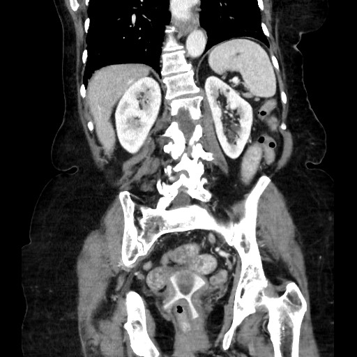 Closed loop small bowel obstruction due to adhesive band, with intramural hemorrhage and ischemia (Radiopaedia 83831-99017 C 85).jpg