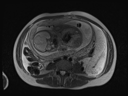 File:Closed loop small bowel obstruction in pregnancy (MRI) (Radiopaedia 87637-104031 Axial T2 44).jpg