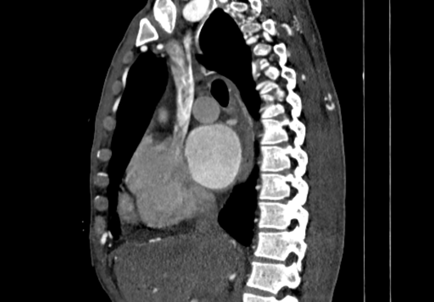Coarctation of aorta with aortic valve stenosis (Radiopaedia 70463-80574 B 31).jpg