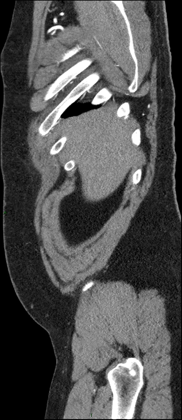 Coarctation of the aorta (Radiopaedia 74632-88521 C 23).jpg