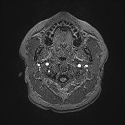 File:Cochlear incomplete partition type III associated with hypothalamic hamartoma (Radiopaedia 88756-105498 Axial T1 14).jpg