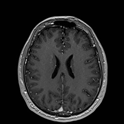 Cochlear incomplete partition type III associated with hypothalamic hamartoma (Radiopaedia 88756-105498 Axial T1 C+ 125).jpg