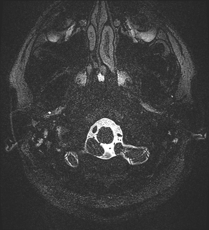 Cochlear incomplete partition type III associated with hypothalamic hamartoma (Radiopaedia 88756-105498 Axial T2 10).jpg