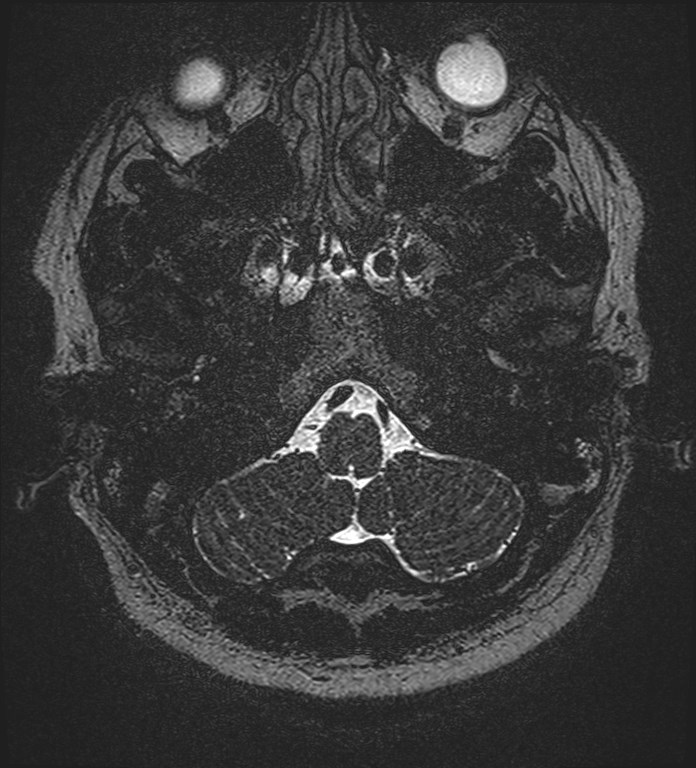 Cochlear incomplete partition type III associated with hypothalamic hamartoma (Radiopaedia 88756-105498 Axial T2 26).jpg